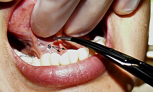 A frenulotomy is said to make Koreans' pronunciation of English better.